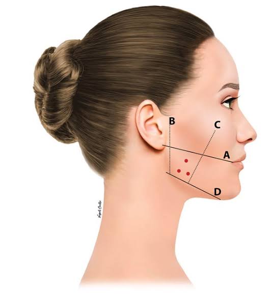 masseter botox